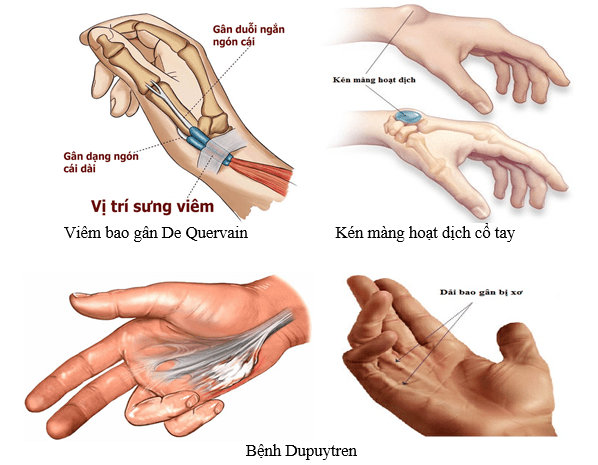 Hội chứng De Quervain (Viêm bao gân De Quervain)