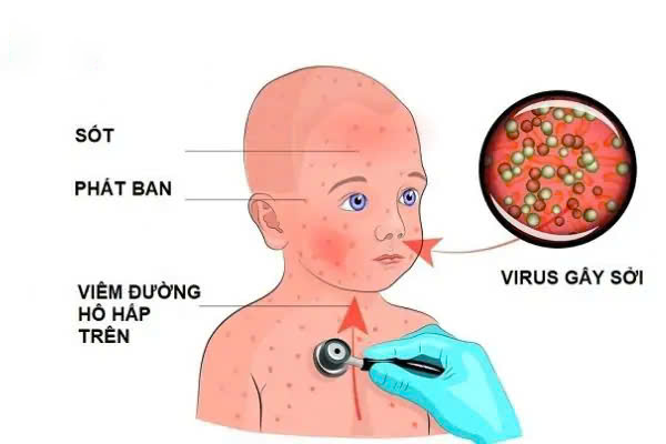 Bệnh Sởi Ở Trẻ Em: 5 Dấu Hiệu & Cách Chăm Sóc Tại Nhà