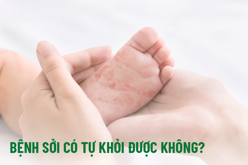 Bệnh Sởi Có Tự Khỏi Không? 4 Biến Chứng Nguy Hiểm Cần Tránh