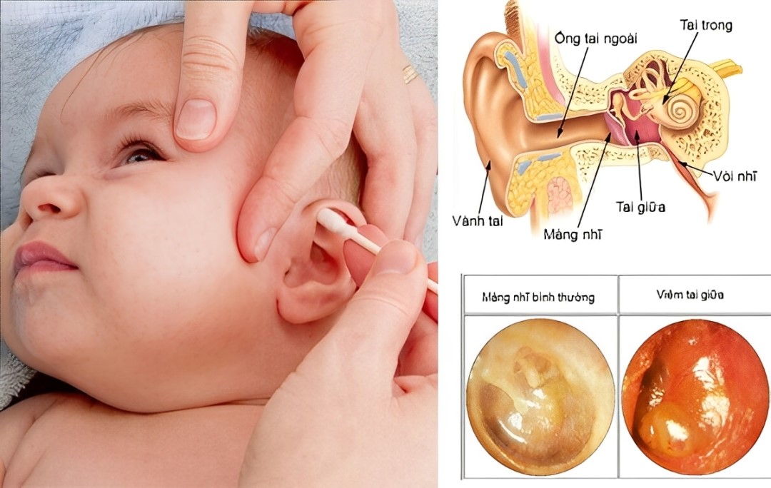 Trẻ bị sởi có thể biến chứng gây viêm tai giữa