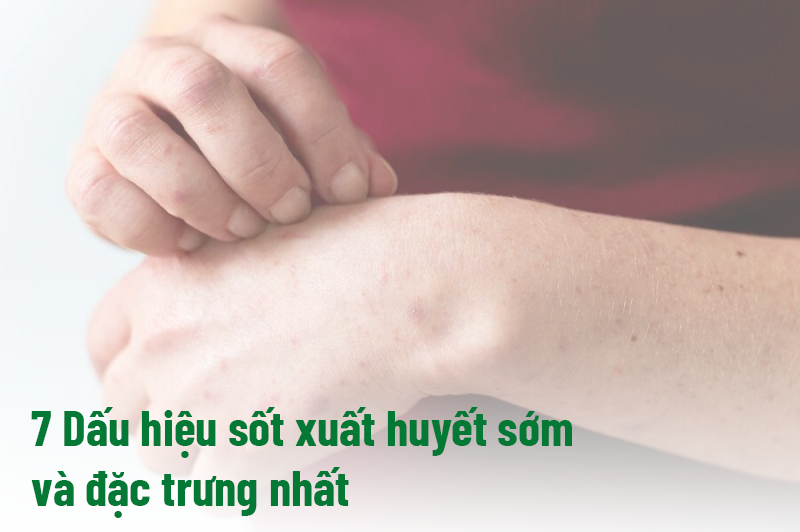 7 Dấu hiệu sốt xuất huyết sớm và đặc trưng nhất bà con cần biết
