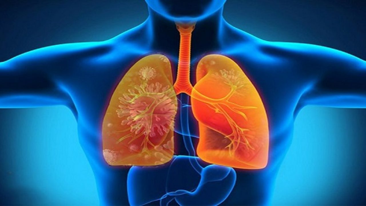 5 Dấu hiệu viêm phổi cảnh báo tình trạng nguy hiểm cần nhập viện ngay