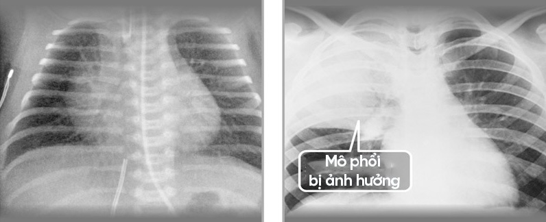 Hình ảnh minh họa so sánh phổi khỏe mạnh và phổi bị viêm do viêm phổi, với các phế nang chứa đầy dịch.