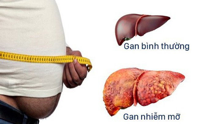 Gan Nhiễm Mỡ Độ 1, 2, 3: Nguyên Nhân & Chế Độ Ăn Uống