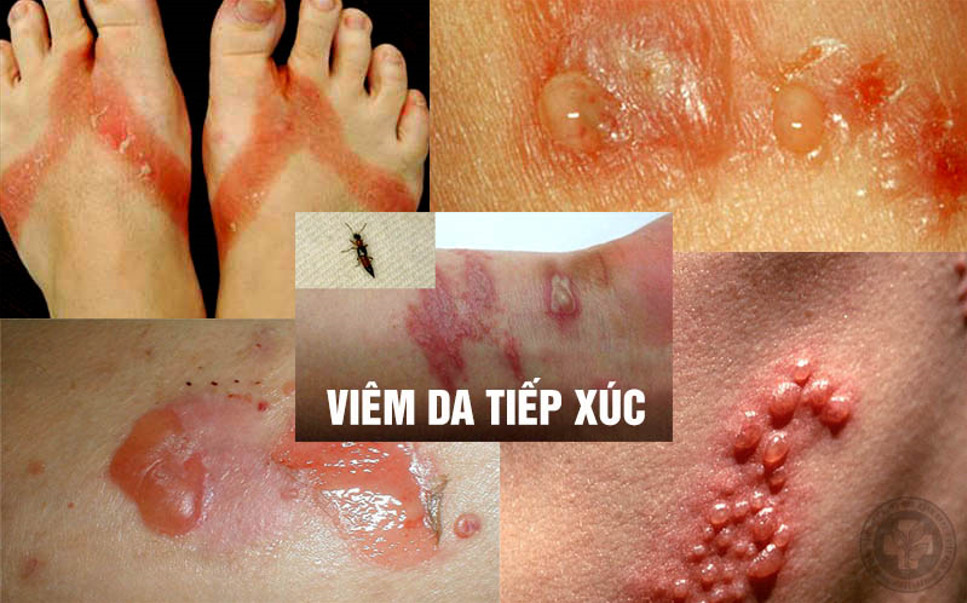 Viêm Da Tiếp Xúc: 5 Nguyên Nhân & Cách Xử Lý Nhanh