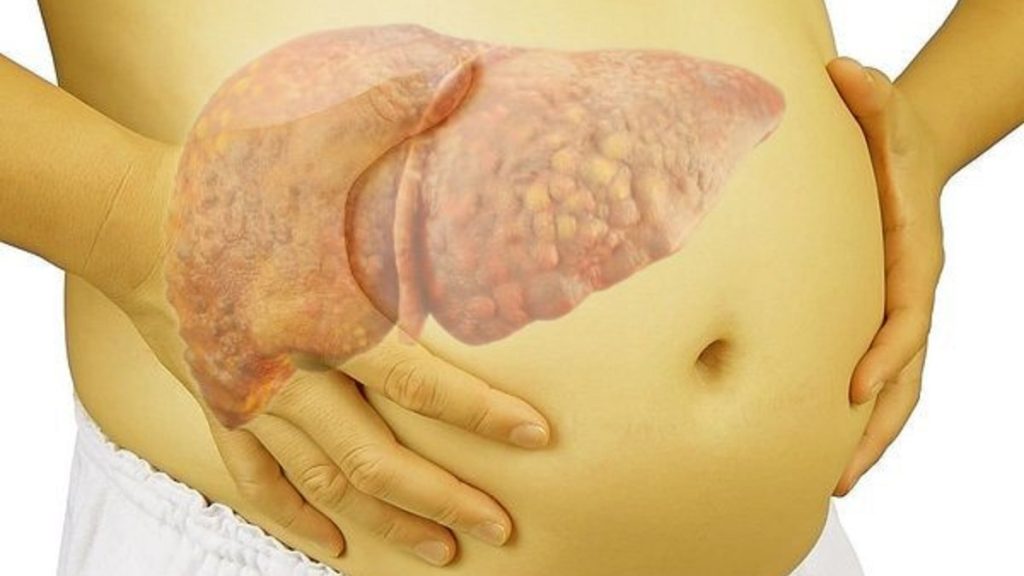 Bệnh Xơ Gan: 4 Giai Đoạn Phát Triển & Dấu Hiệu Cổ Trướng