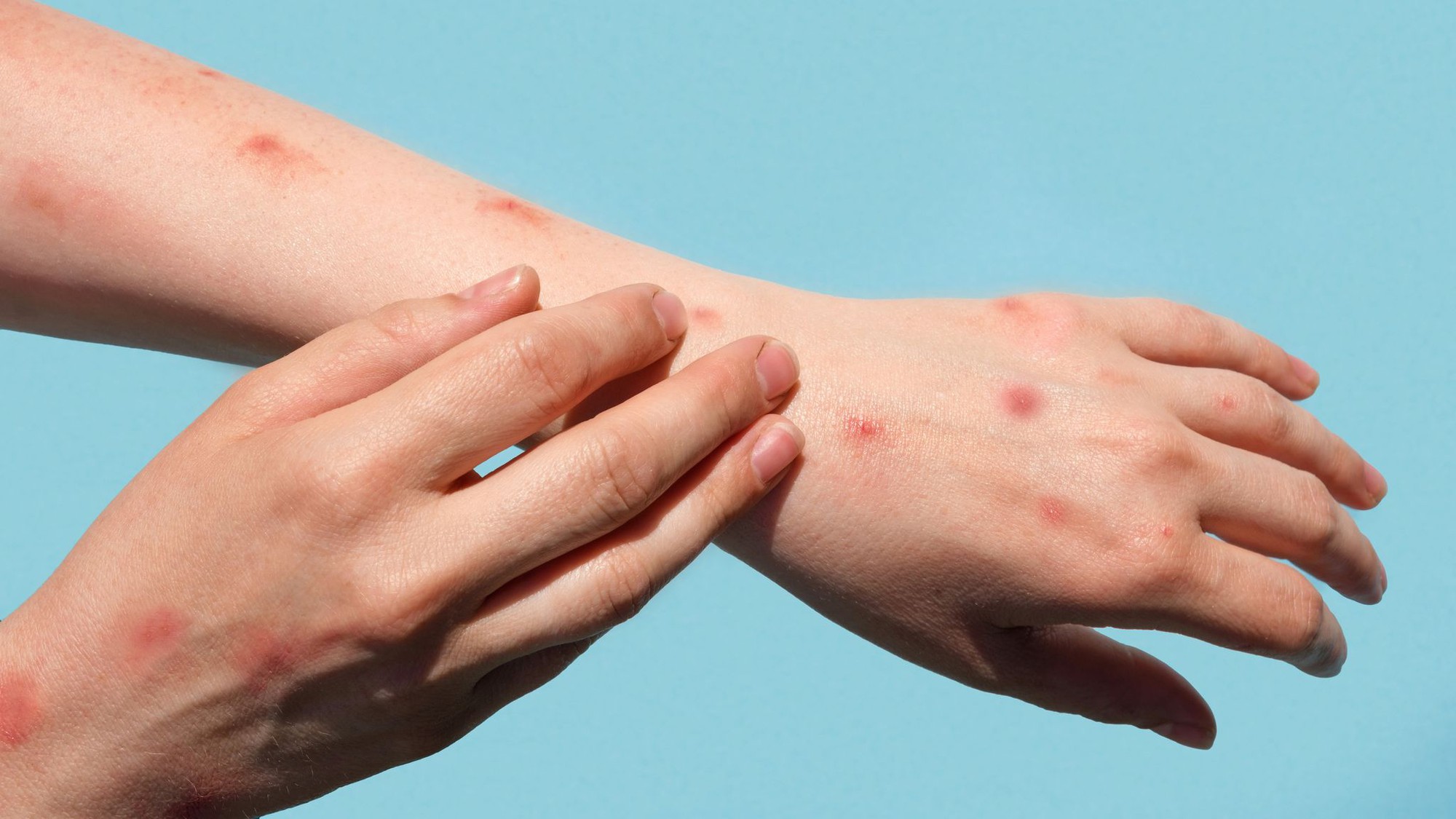 Bệnh Đậu Mùa Khỉ: 5 Triệu Chứng Điển Hình & Cách Phòng Lây