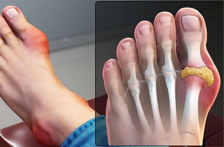 Bệnh Gout (Gút): 5 Dấu Hiệu Nhận Biết & Thực Đơn Ăn Kiêng