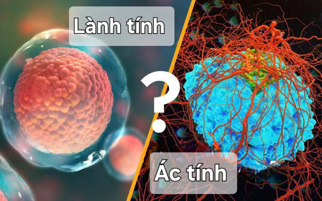 Khối U Là Gì? 4 Cách Phân Biệt U Lành & U Ác Tính
